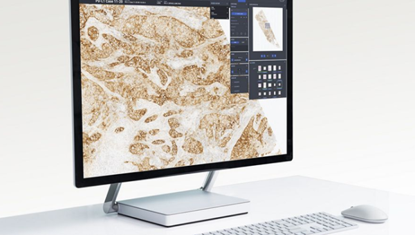 Nuevas Herramientas para el Diagnóstico de Cáncer de Mama