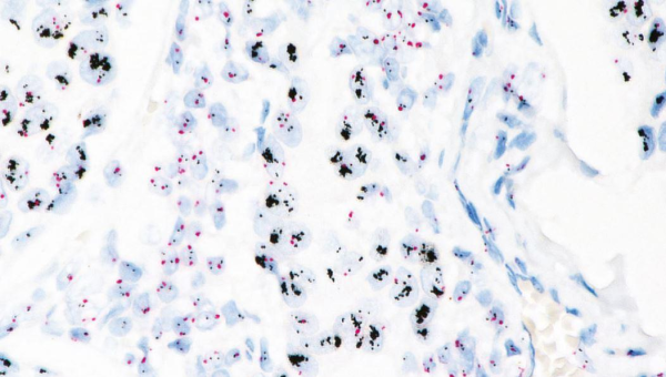 Interpretación Her-2 Dual ISH Interpretación Her-2 Dual ISH