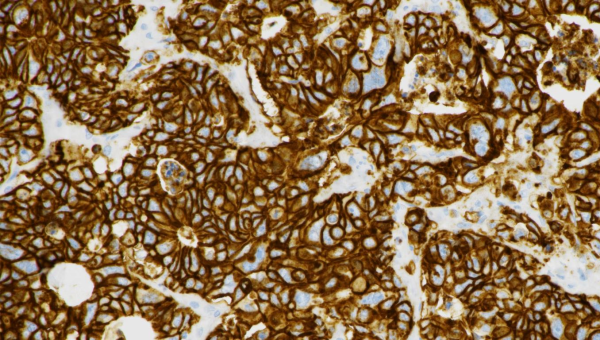 Novedades en biomarcadores gástricos